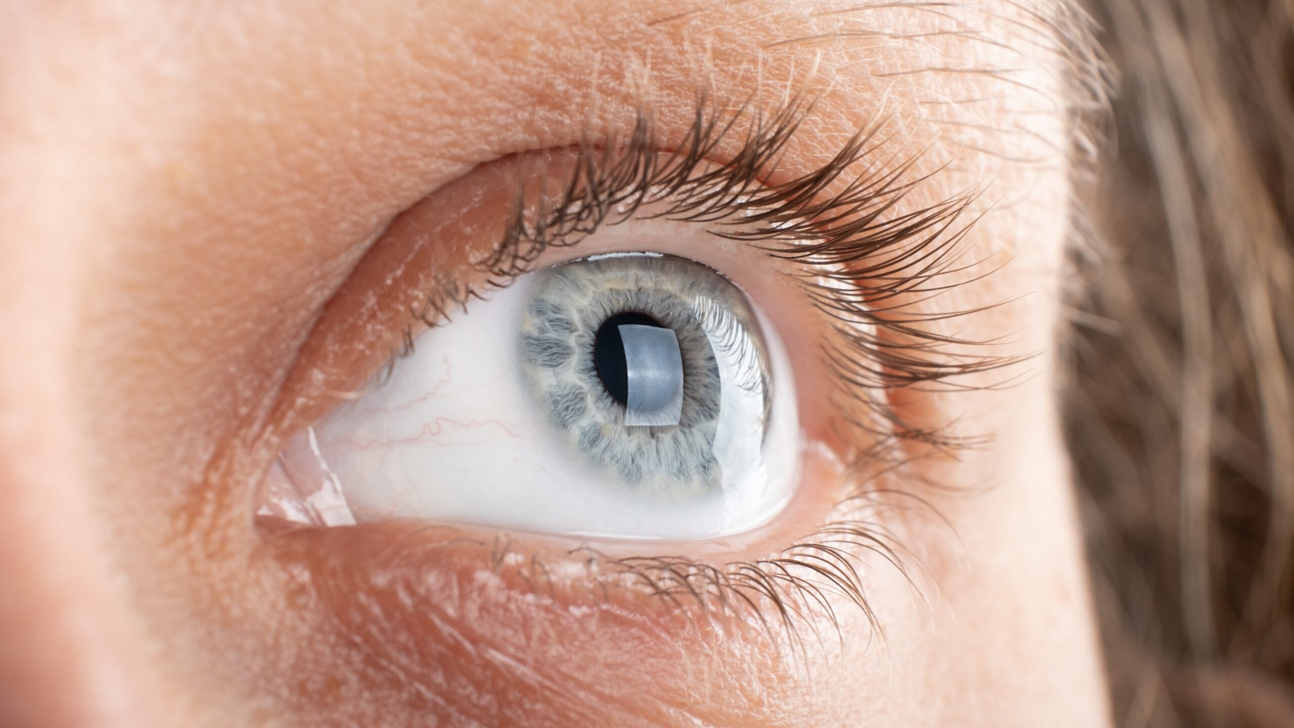 corneal transplant